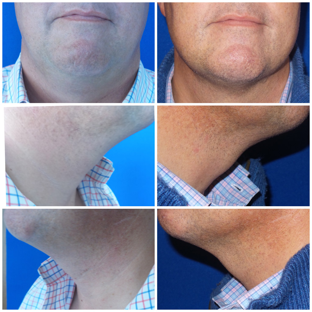 Before and After image of a man with Kybella from Refresh Aesthetic Center in Whitefish Bay WI