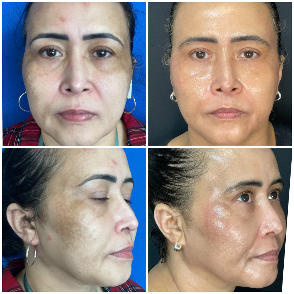 Moxi Before and After image from Refresh Aesthetic Center in Whitefish WI