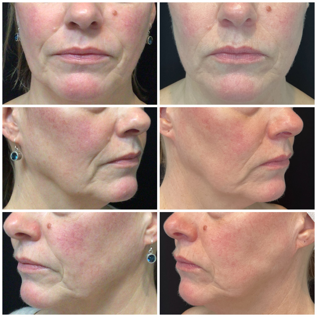 BBL Facial Photofacial, Before & After image from Refresh Aesthetic Center in Whitefish Bay WI