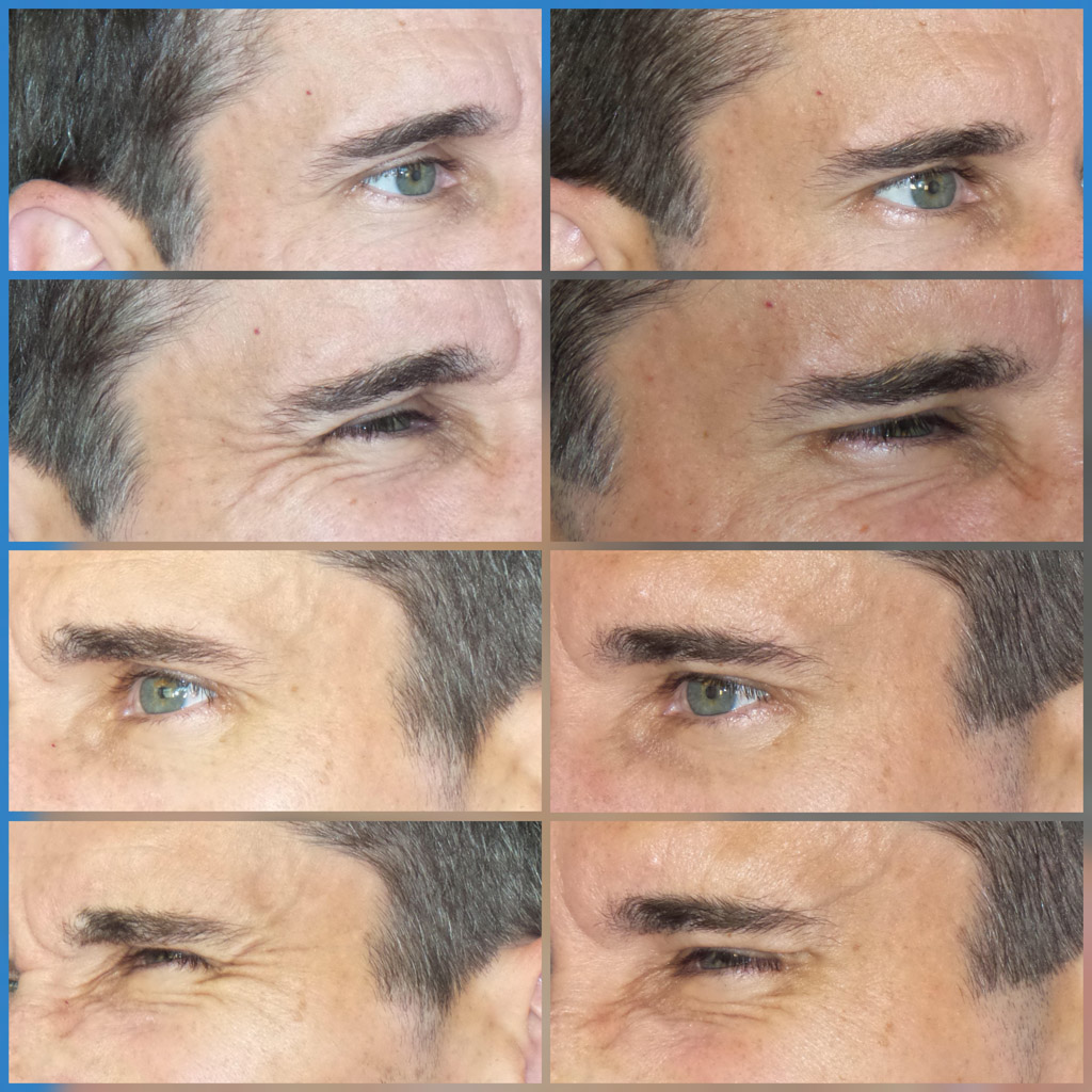 Male with BOTOX Before and After images from Refresh Aesthetic Center in Whitefish Bay WI
