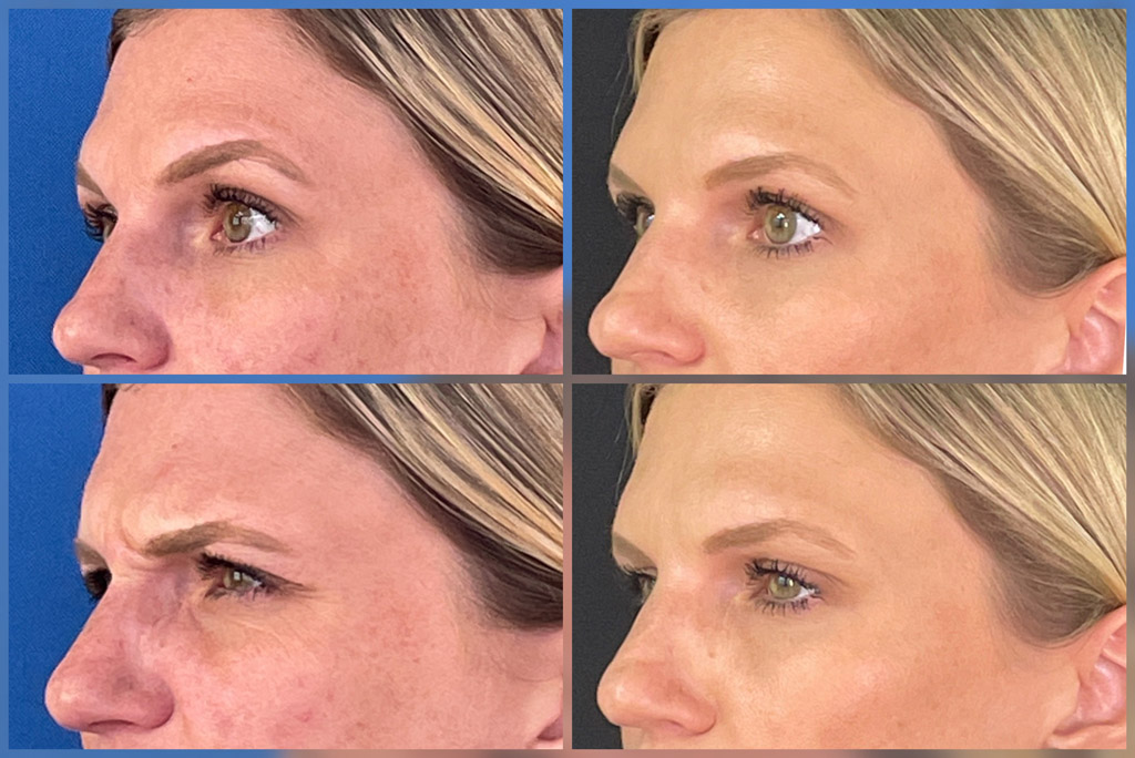 Woman with BOTOX Before and After images from Refresh Aesthetic Center in Whitefish Bay WI