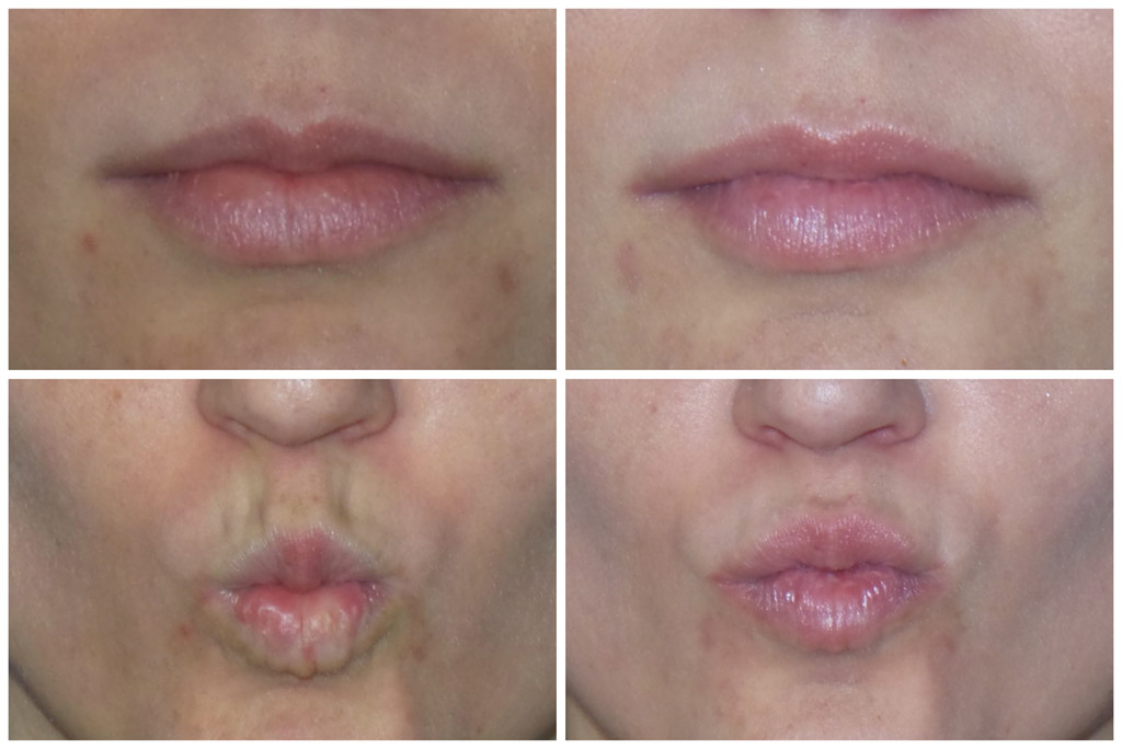 Woman with BOTOX Before and After lips images from Refresh Aesthetic Center in Whitefish Bay WI