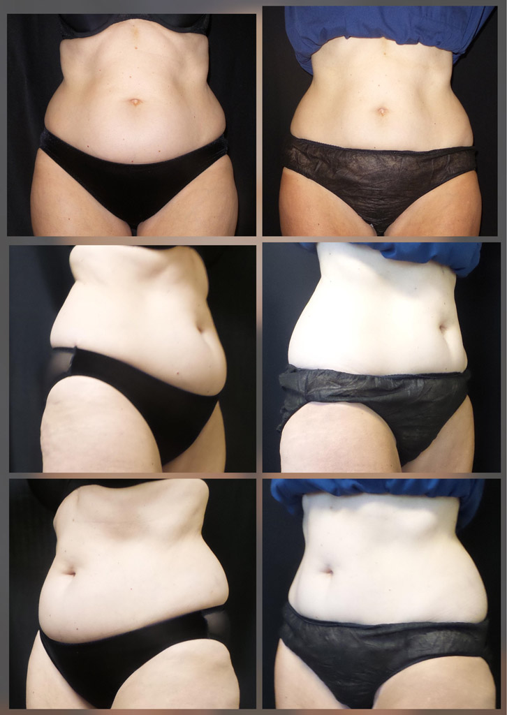 CoolSculpting, Before and After image from Refresh Aesthetic Center