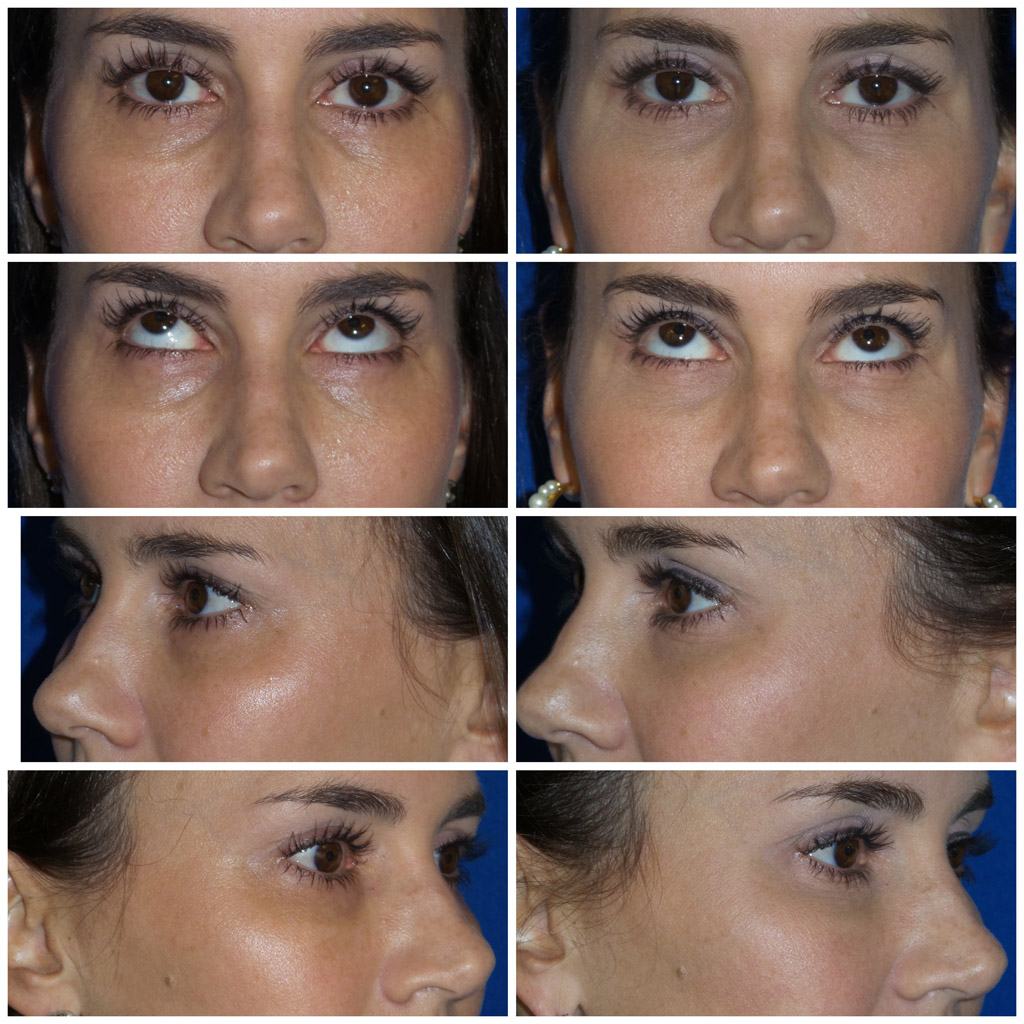Eye Trough Filler Before and After image from Refresh Aesthetic Center in Whitefish Bay WI