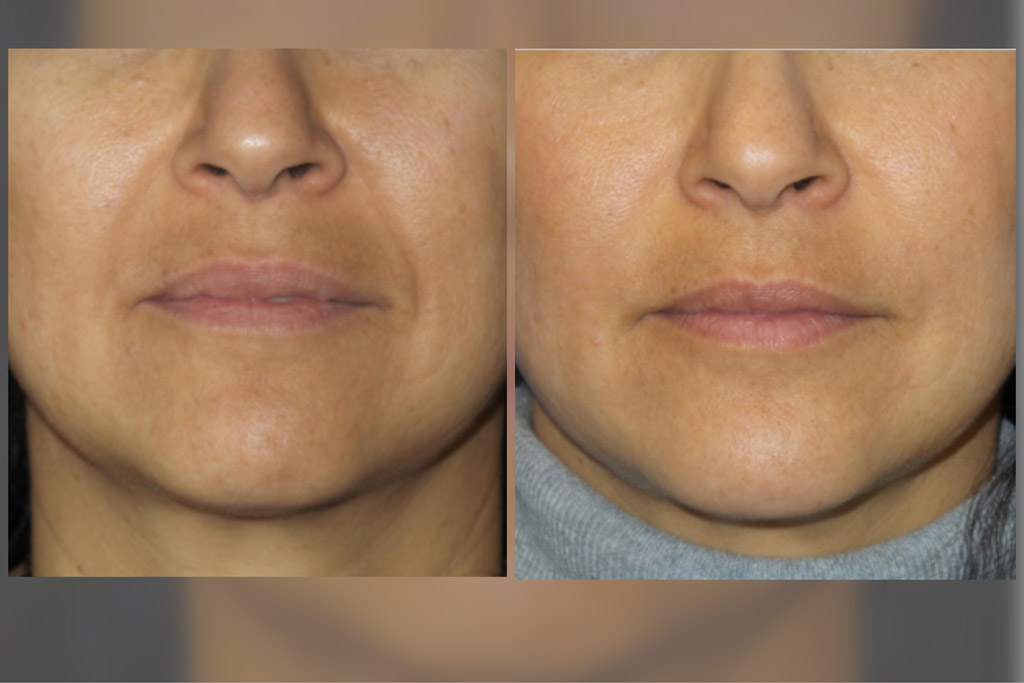 Face Filler Before and After image from Refresh Aesthetic Center in Whitefish Bay WI