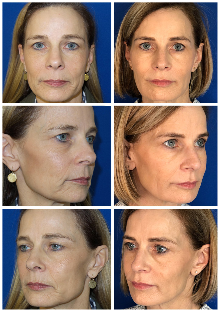 Full Face Filler Before and After image from Refresh Aesthetic Center in Whitefish Bay WI
