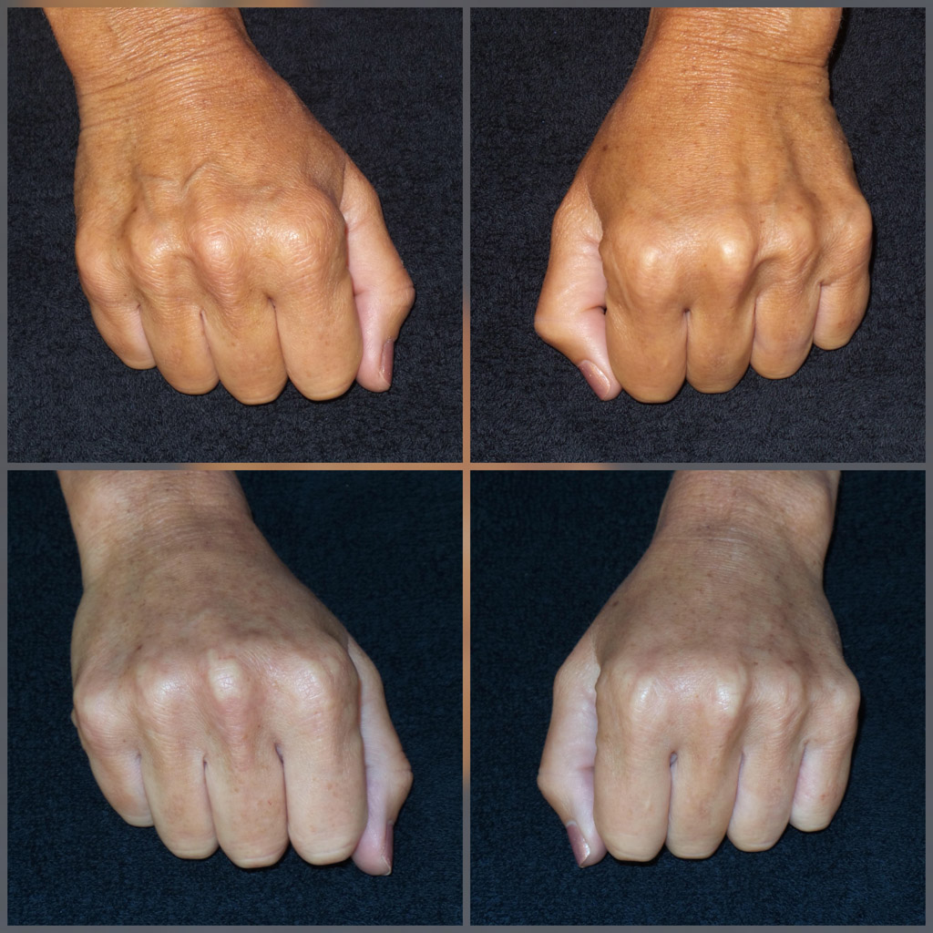 Hand Filler Before and After image from Refresh Aesthetic Center in Whitefish Bay WI