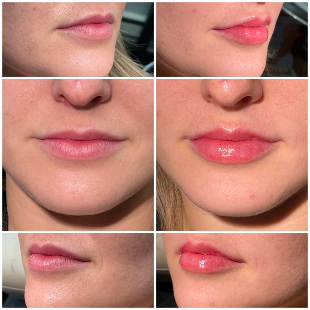 Lip Filler Before and After image from Refresh Aesthetic Center in Whitefish Bay WI