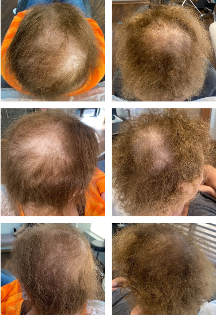 PRP, Before and After image from Refresh Aesthetic Center