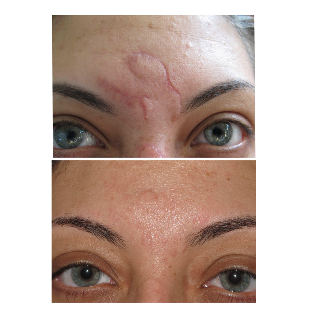 Scar Treatment, Before and After image from Refresh Aesthetic Center