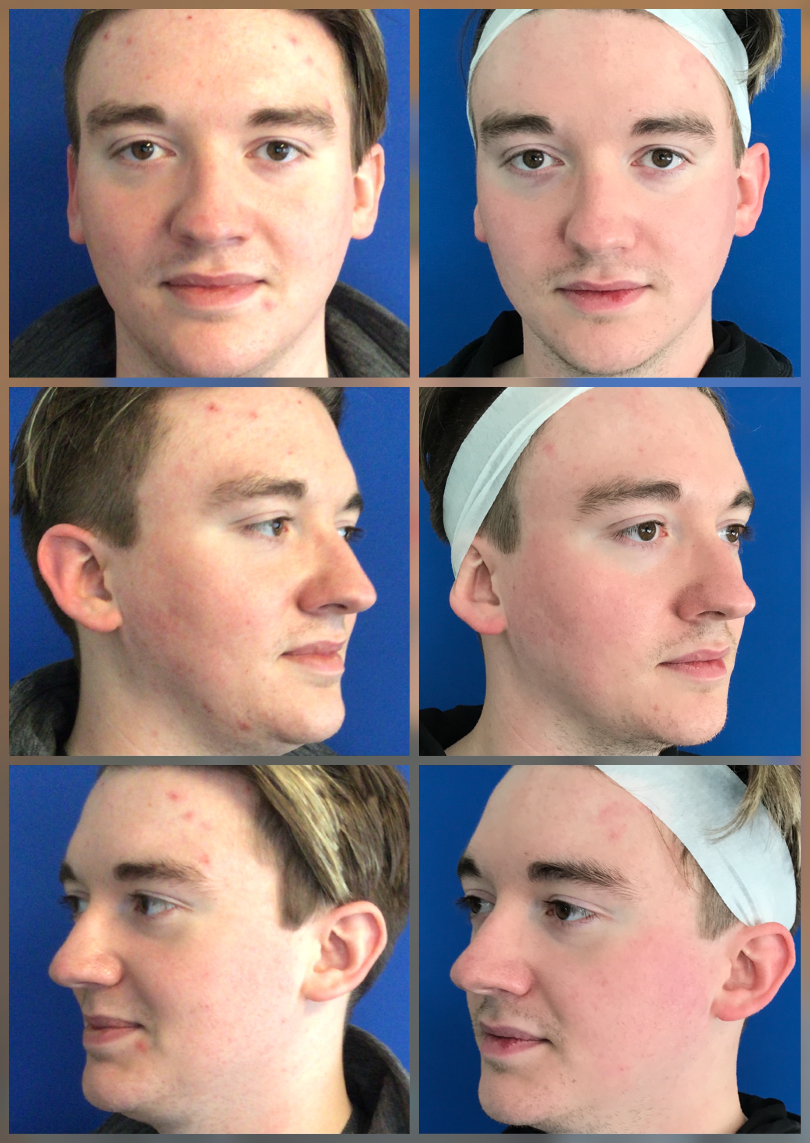 Skincare Before and After image from Refresh Aesthetic Center in Whitefish WI