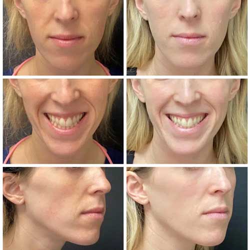 Sculptra, Before and After image from Refresh Aesthetic Center