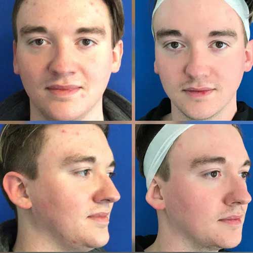 Skincare, Before and After image from Refresh Aesthetic Center