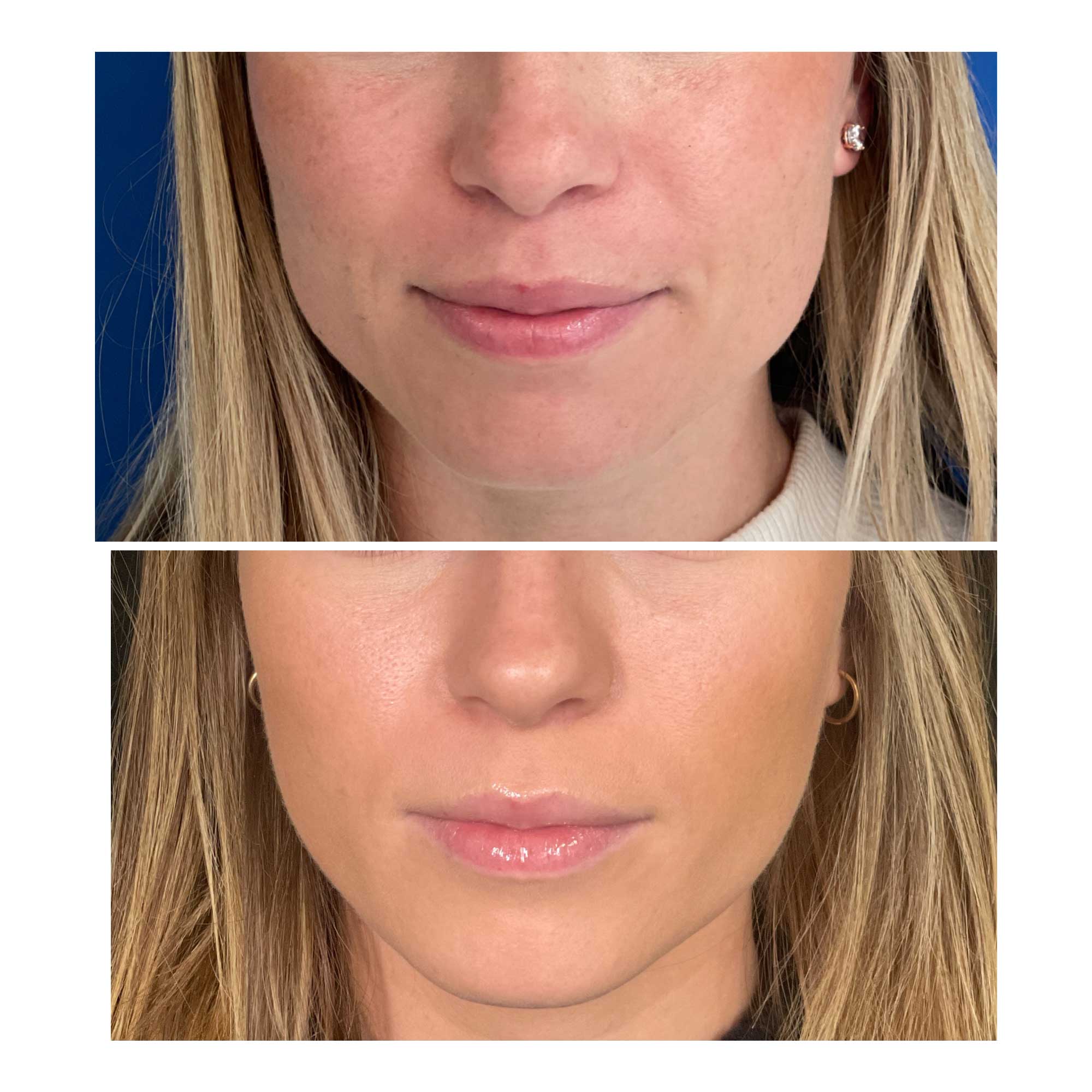 Woman's Masseters with BOTOX Before and After images from Refresh Aesthetic Center in Whitefish Bay WI