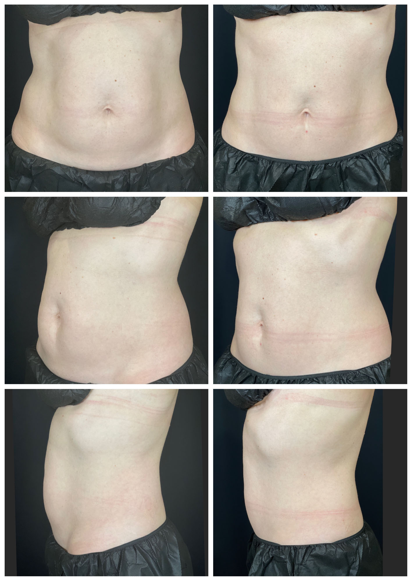 Abdomen CoolSculpting Before and After images from Refresh Aesthetic Center