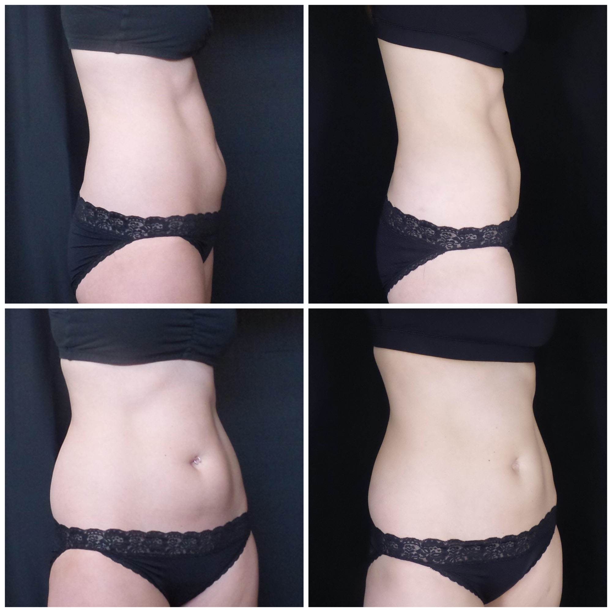 Abdomen CoolSculpting Before and After images from Refresh Aesthetic Center