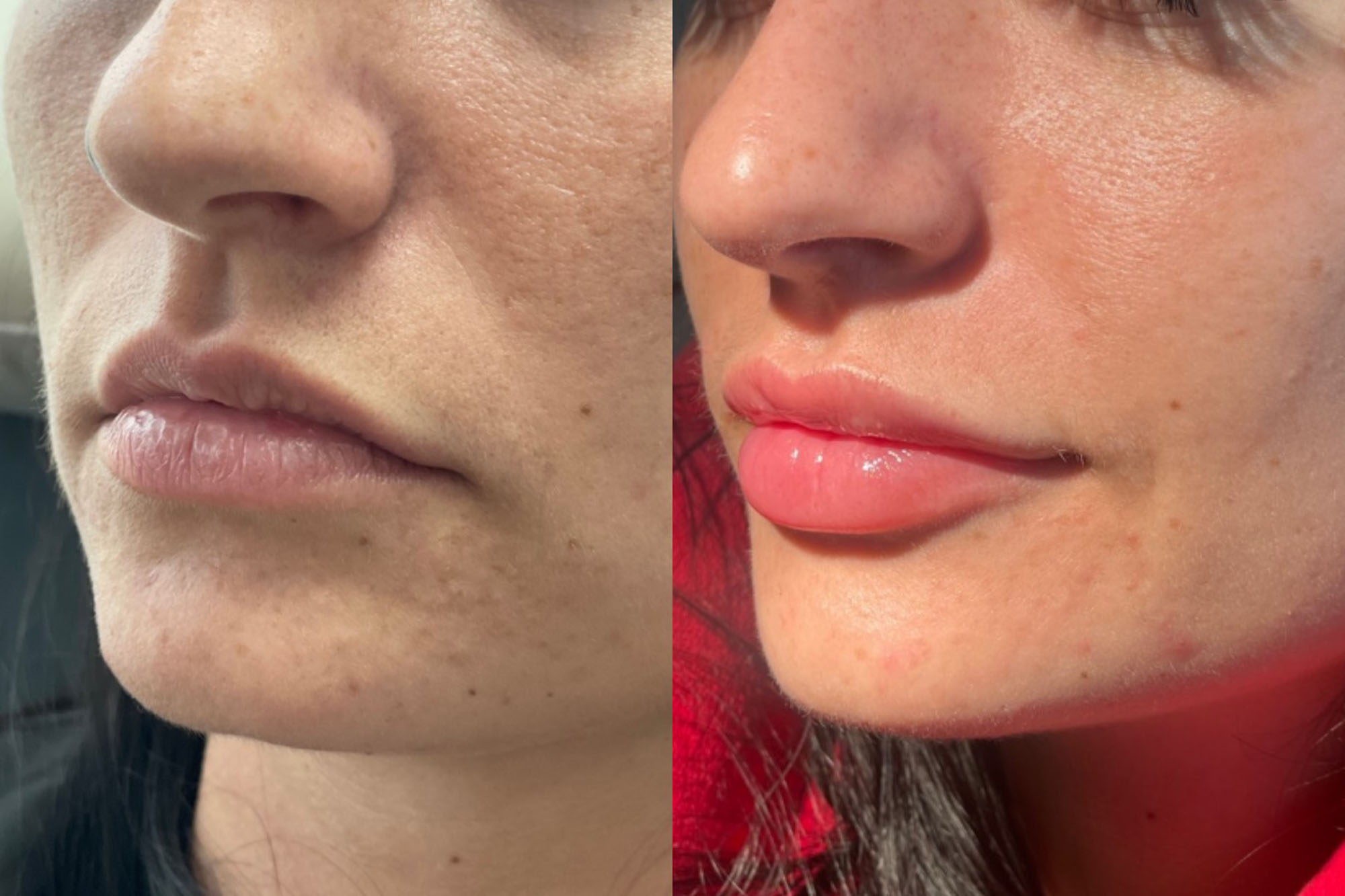 Lip Filler Before and After image from Refresh Aesthetic Center in Whitefish Bay WI