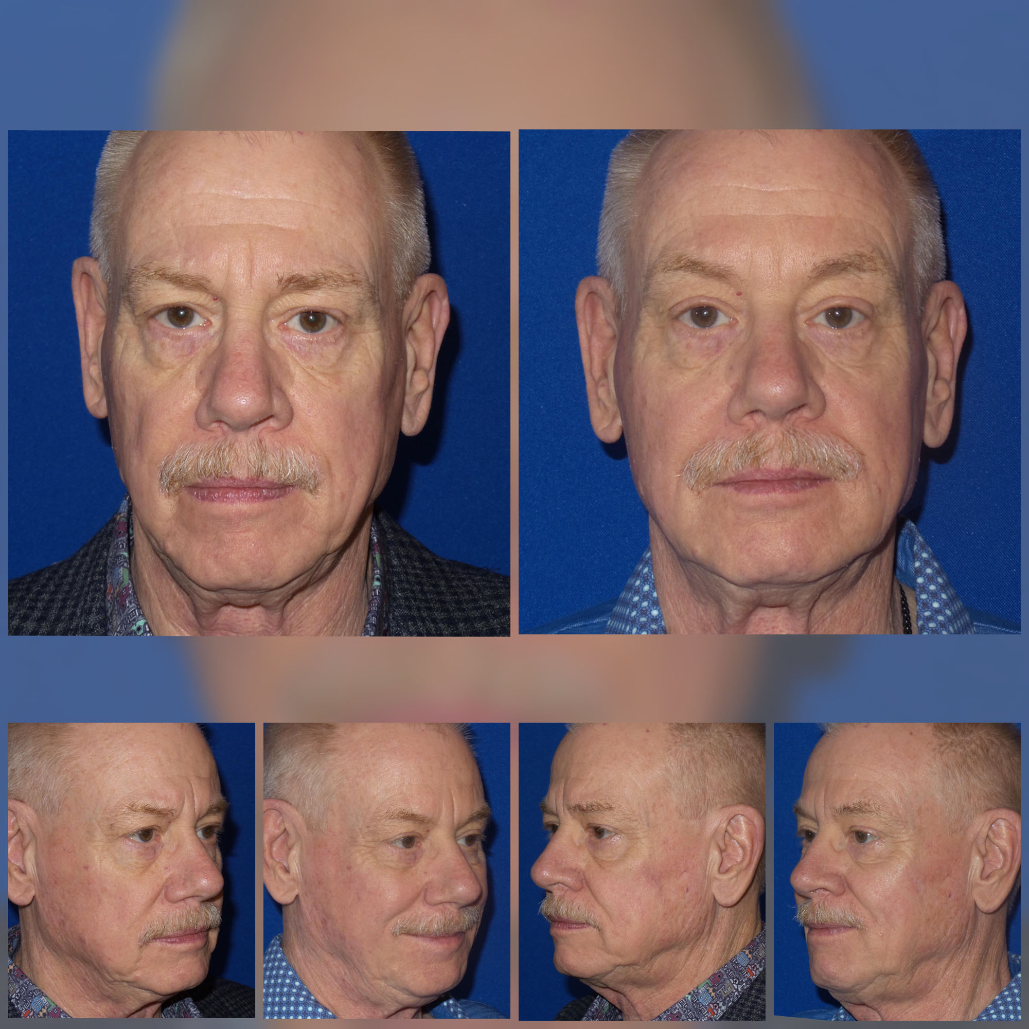 Mid & Full Face Filler Before and After photos from Refresh Aesthetic Center in Whitefish Bay WI