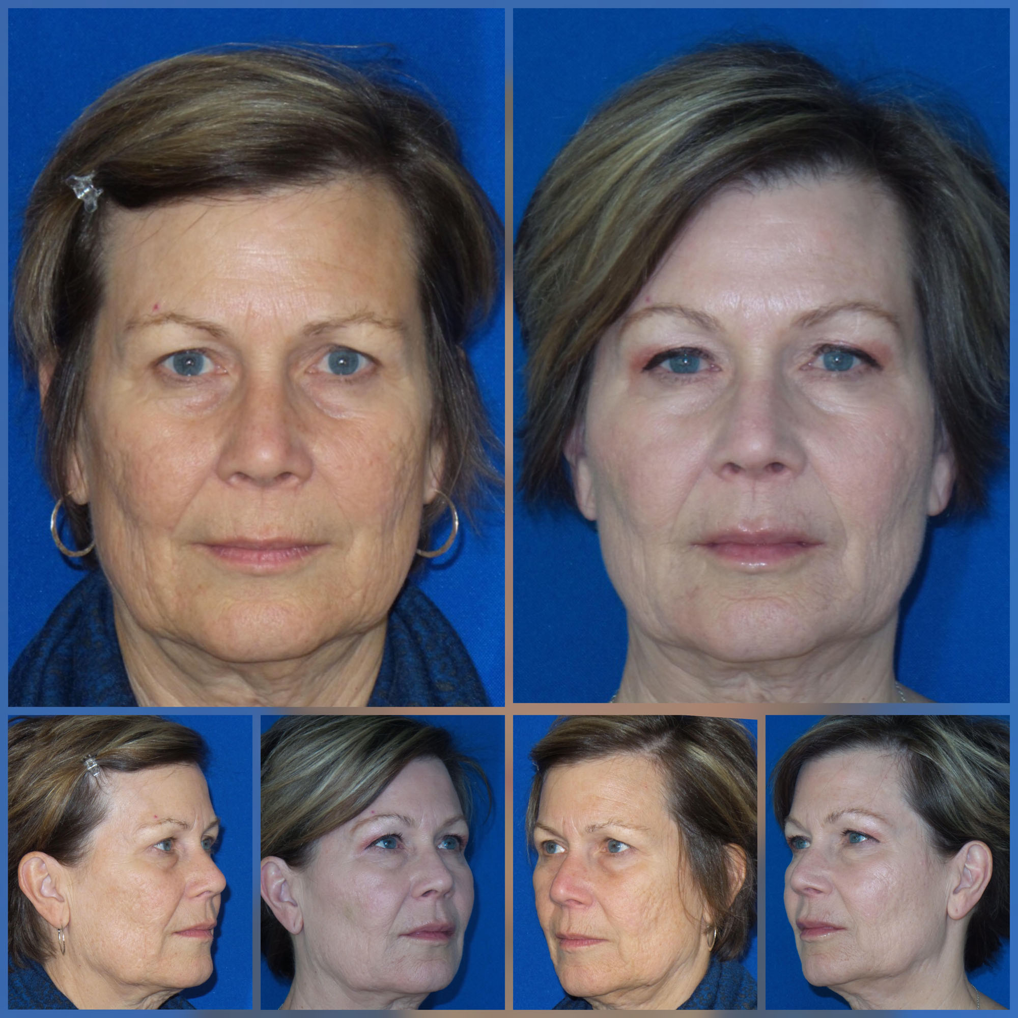 Mid & Full Face Filler Before and After photos from Refresh Aesthetic Center in Whitefish Bay WI