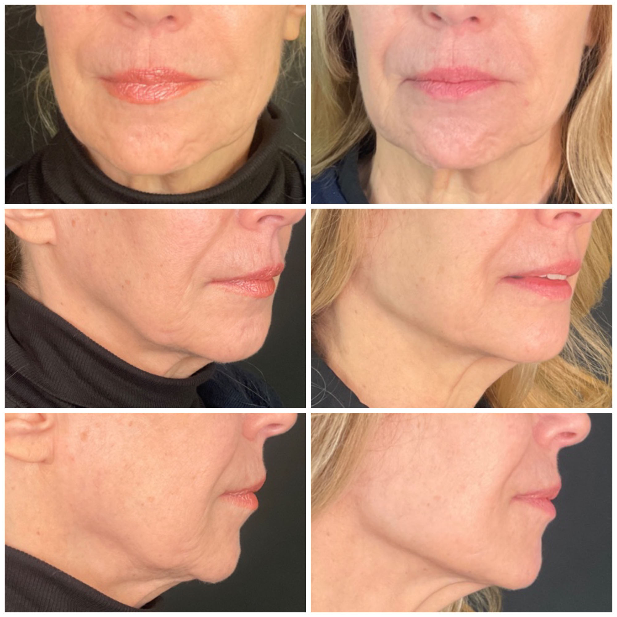Jawline Contouring Filler Before and After images from Refresh Aesthetic Center in Whitefish Bay WI