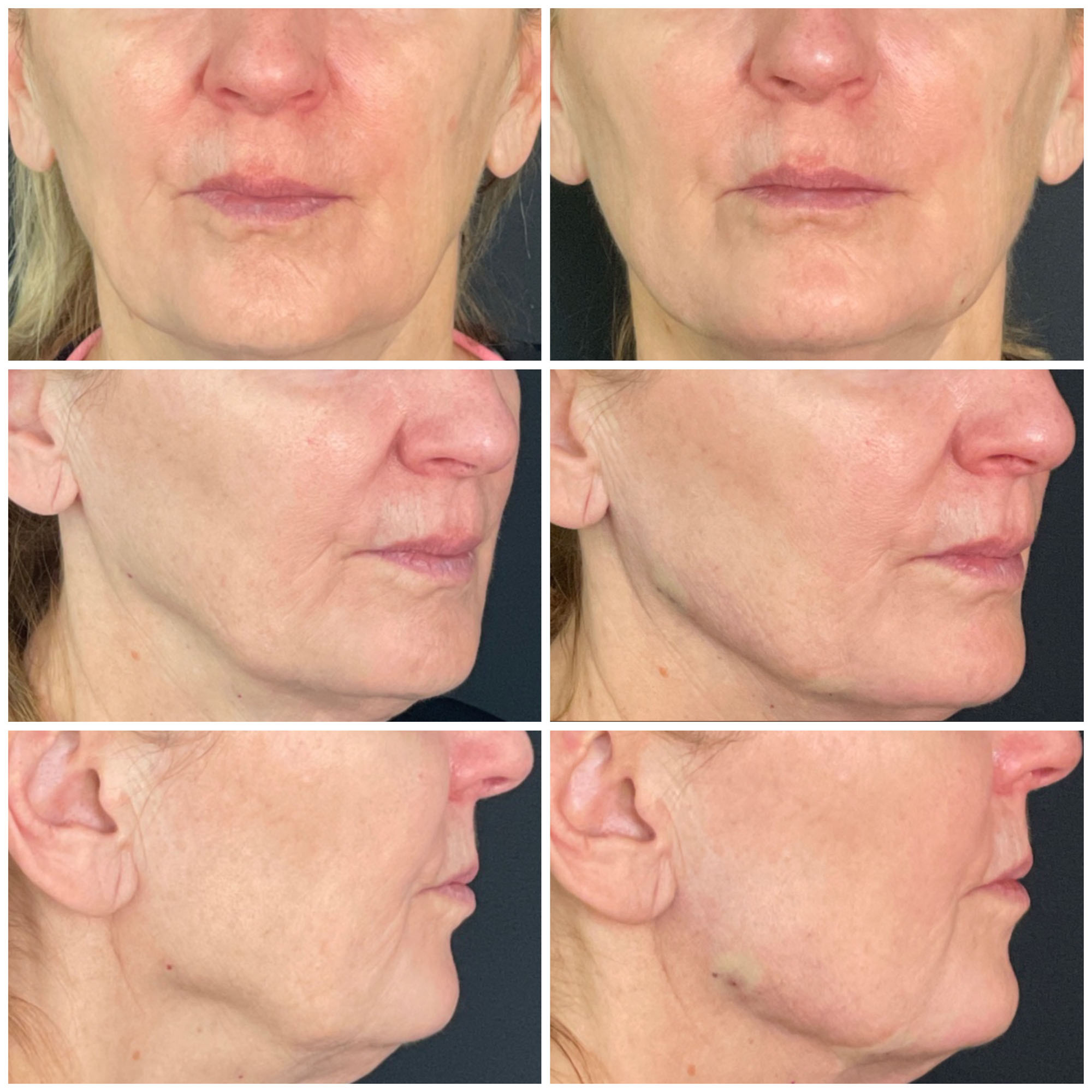 Jawline Contouring Filler Before and After images from Refresh Aesthetic Center in Whitefish Bay WI