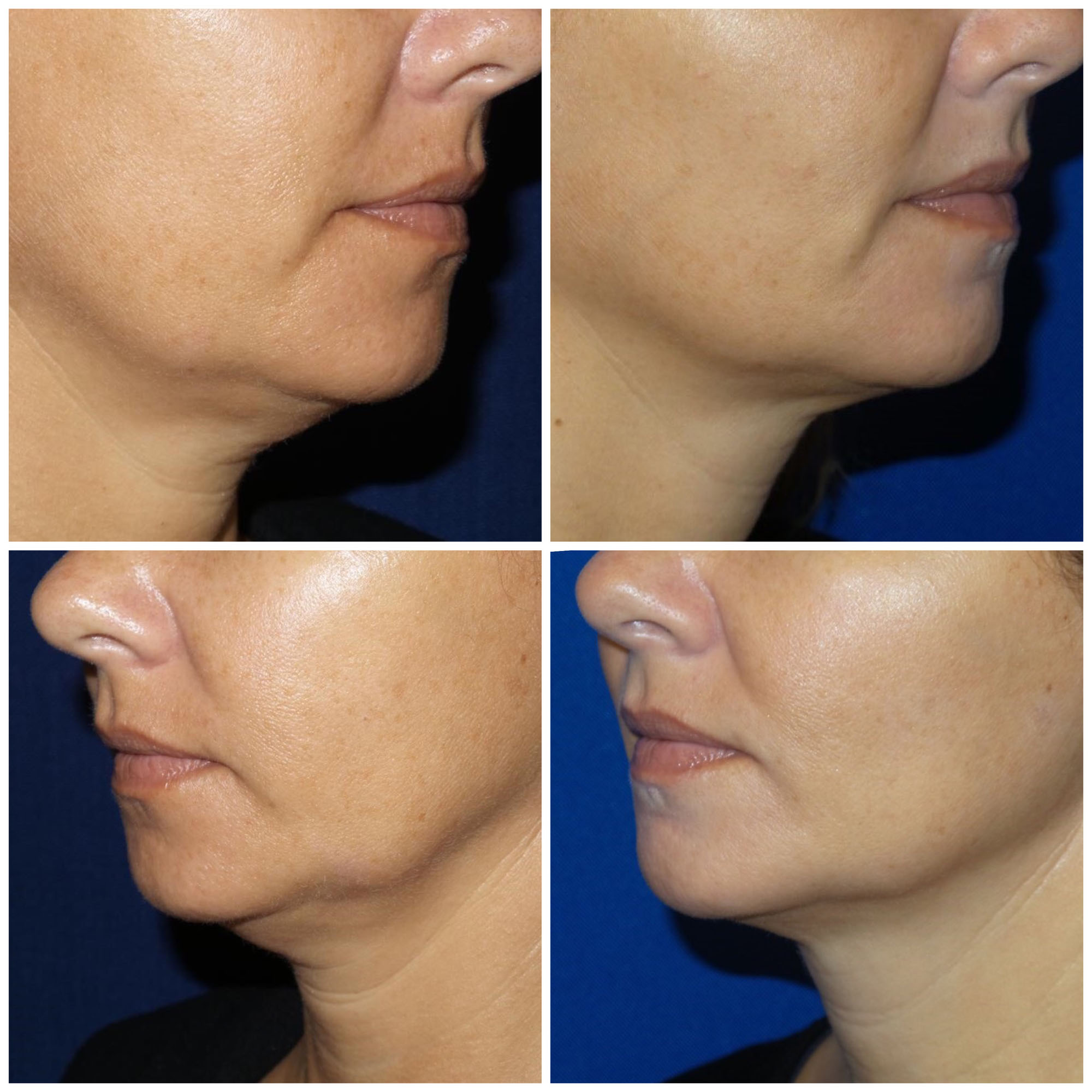 Before and After image of a woman with Kybella combined with filler to the chin from Refresh Aesthetic Center in Whitefish Bay WI
