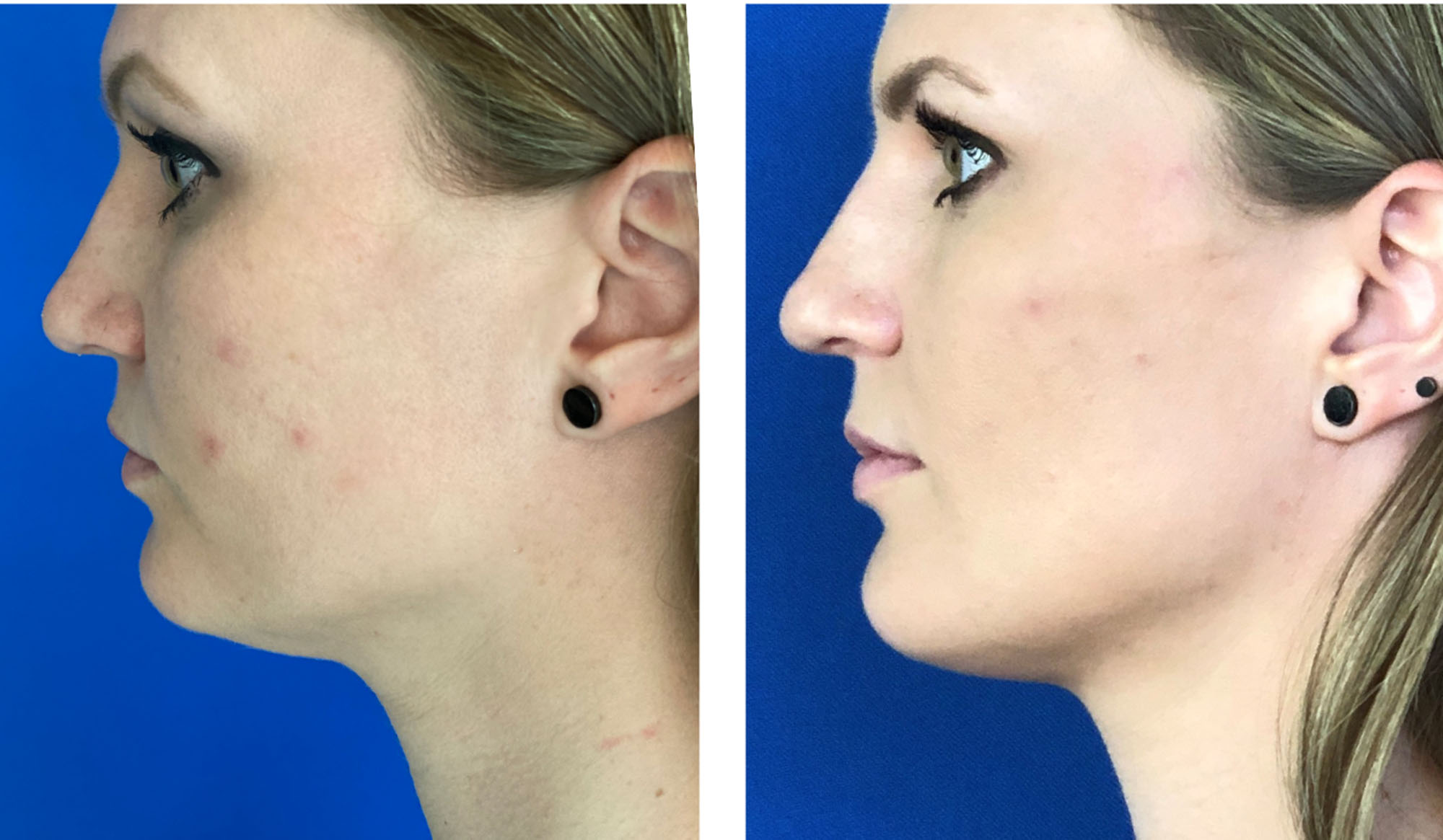 Before and After image of a woman with Kybella combined with filler to the chin from Refresh Aesthetic Center in Whitefish Bay WI