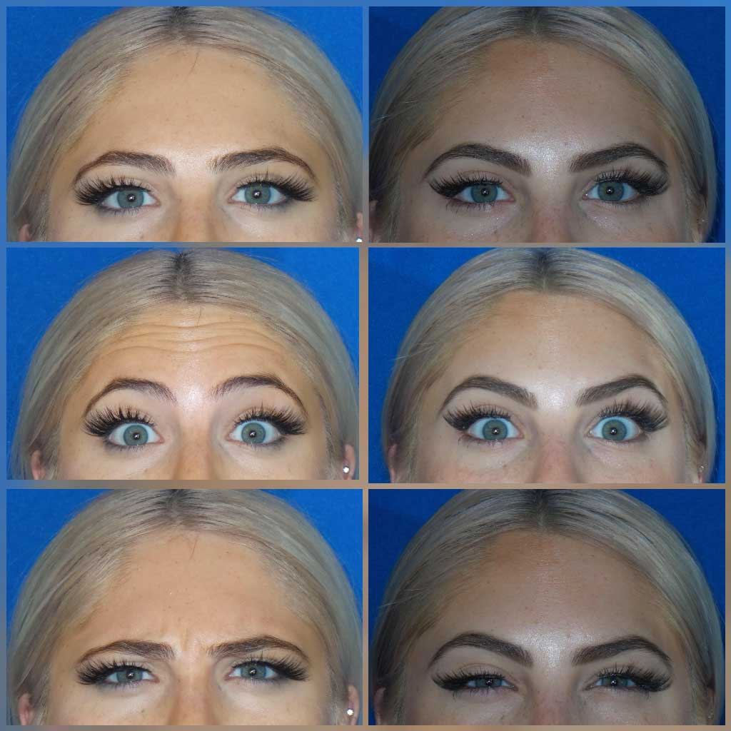 Woman with BOTOX Before and After images from Refresh Aesthetic Center in Whitefish Bay WI