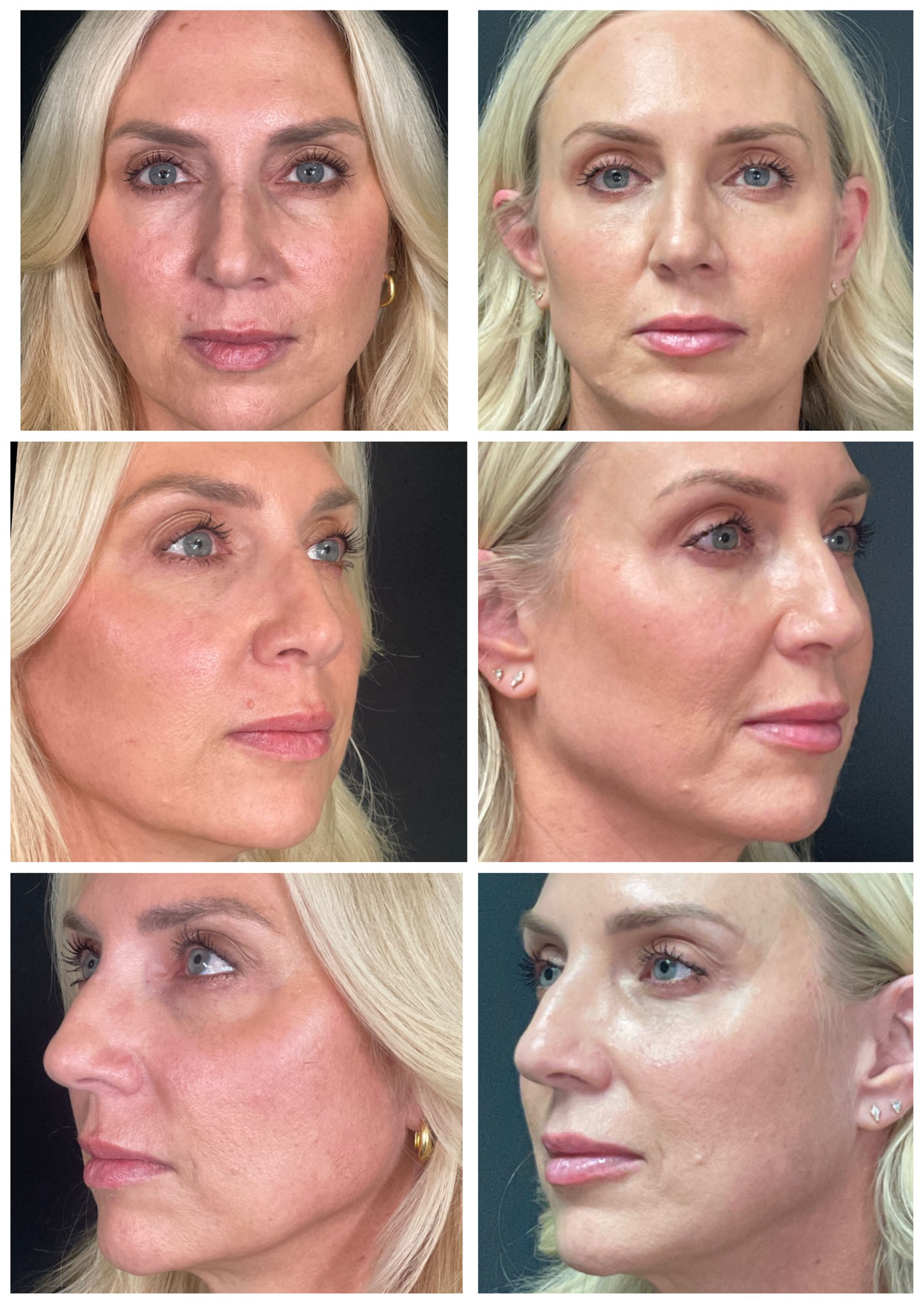 Sculptra Face Before and After images from Refresh Aesthetic Center in Whitefish Bay WI