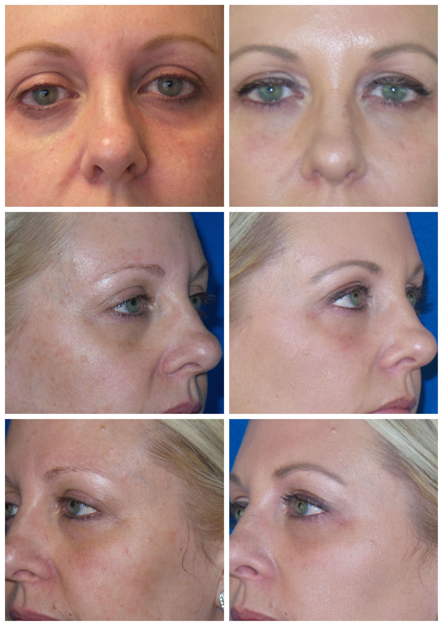 Under-Eye Filler Before and After image from Refresh Aesthetic Center in Whitefish Bay WI